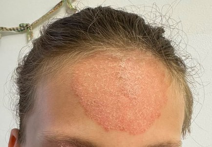 Orticaria pigmentosa
Tinea faciei
