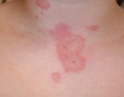 orticaria e artralgie